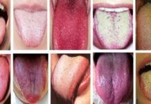 Čo o vašom zdraví hovorí farba vášho jazyka? - LajfHeky