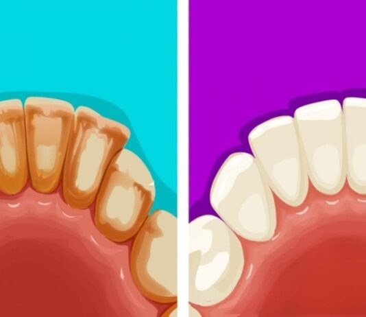 Ako odstrániť zubný kameň