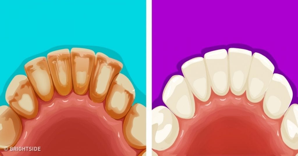 Ako odstrániť zubný kameň